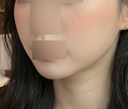 윤곽주사 이중턱 수술후
