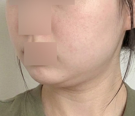 윤곽주사 이중턱 수술전