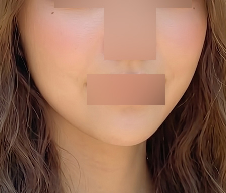 윤곽주사 이중턱 심부볼 수술후