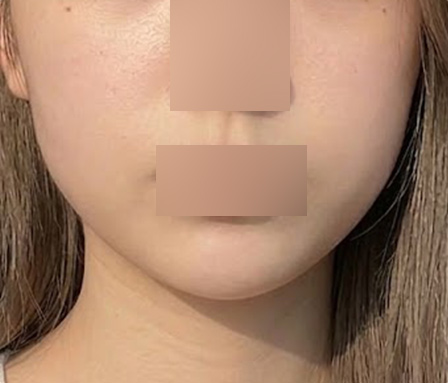 윤곽주사 이중턱 심부볼 수술전