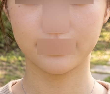 윤곽주사 얼굴전체 수술후