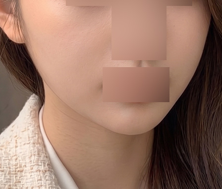 턱라인 심부볼 수술후
