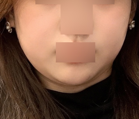 턱라인 심부볼 수술전
