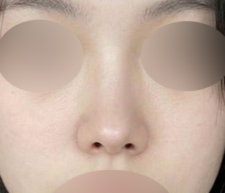 코재수술 수술후