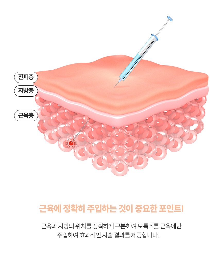 코랄 보톡스 포인트