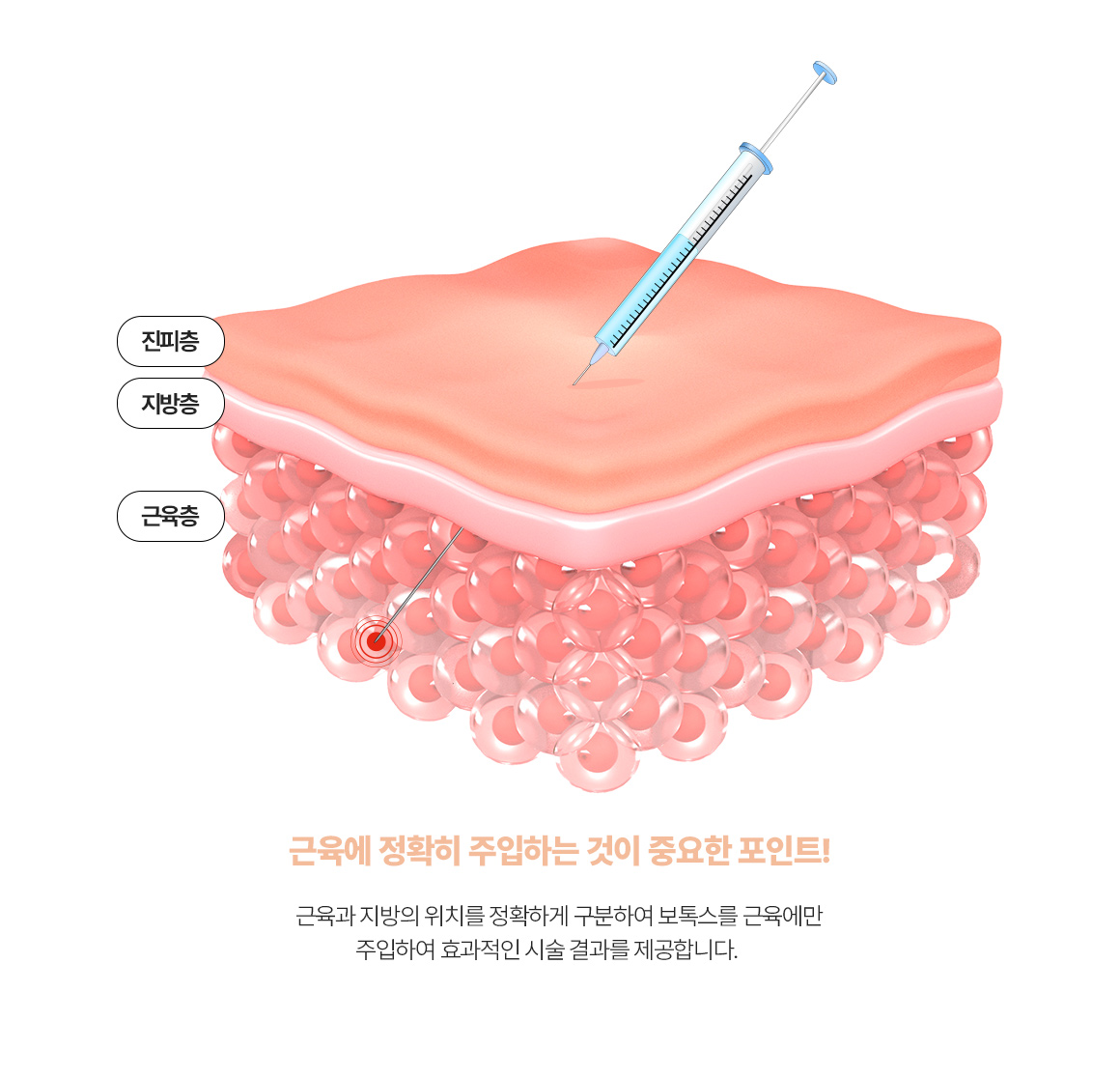 코랄 보톡스 포인트