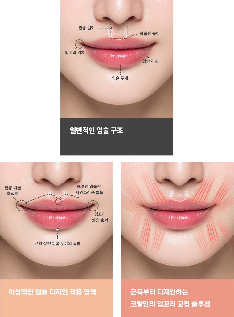 코랄 입꼬리 수술 차별화