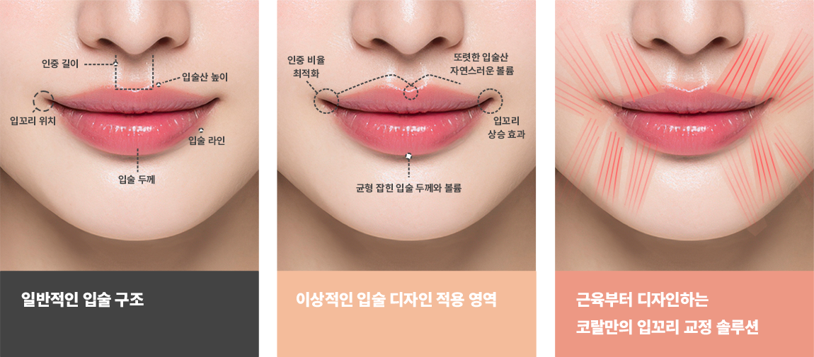코랄 입꼬리 수술 차별화